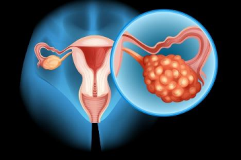 Pcod Treatment In Hyderabad: Finding Support And Solutions With Dr Sunitha Ivf