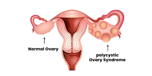 HOW DOES PCOS AFFECT WOMEN’S FERTILITY